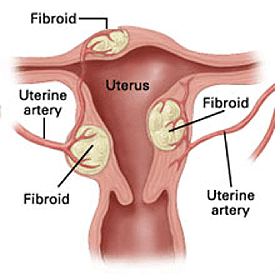 Fibroid Treatment in Hyderabad