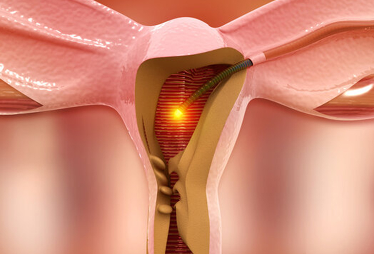 What-to-Expect-From-a-Hysteroscopy-Procedure-for-Improving-Fertility