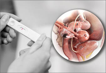 Endometriosis Cause of Infertility