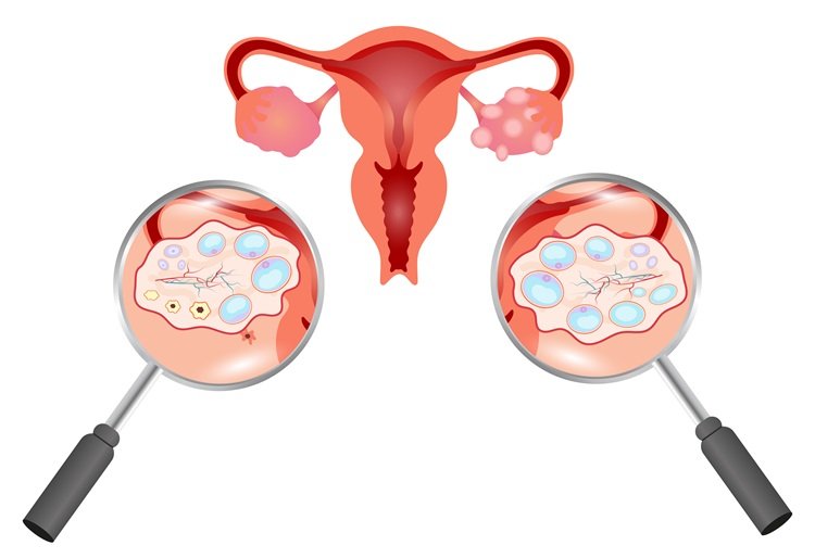 how-pcos-affects-fertility-causes-symptoms-and-effective-treatment-options