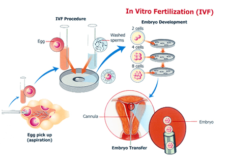 Low Cost IVF Treatment in Hyderabad