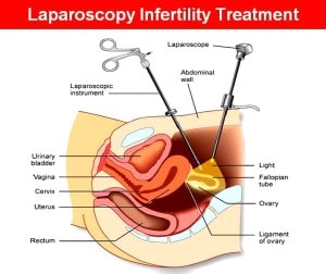 Laparoscopy Cost in Hyderabad