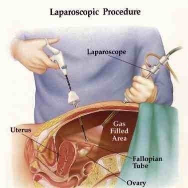 Laparoscopic Surgery in Hyderabad  